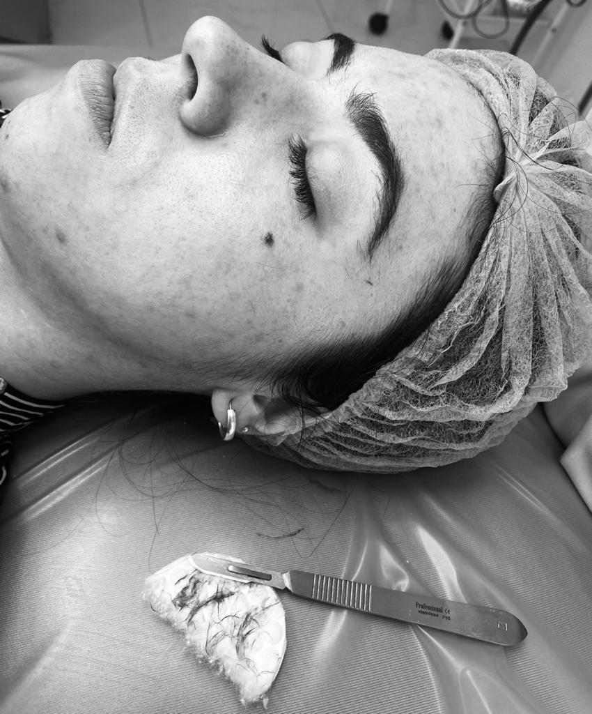 Dermaplaning: Engrossa os pelos?